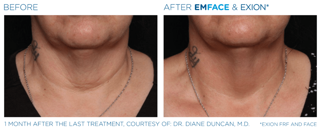 Emface Exion PIC Ba card neck female 003 FRF Face ENUS100 Exion