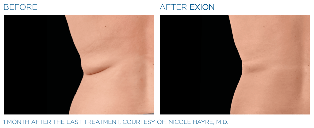 Exion PIC Ba card back female 012 Body ENUS100 Exion