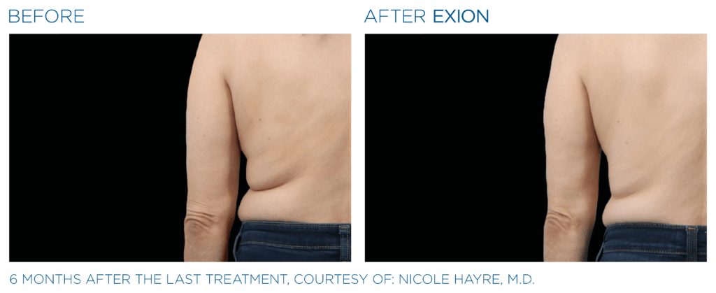 Exion PIC Ba card back female 036 Body ENUS100 Exion