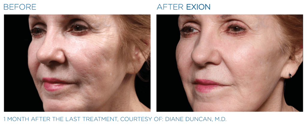 Exion PIC Ba card cheek female 004 FRF ENUS100 Exion