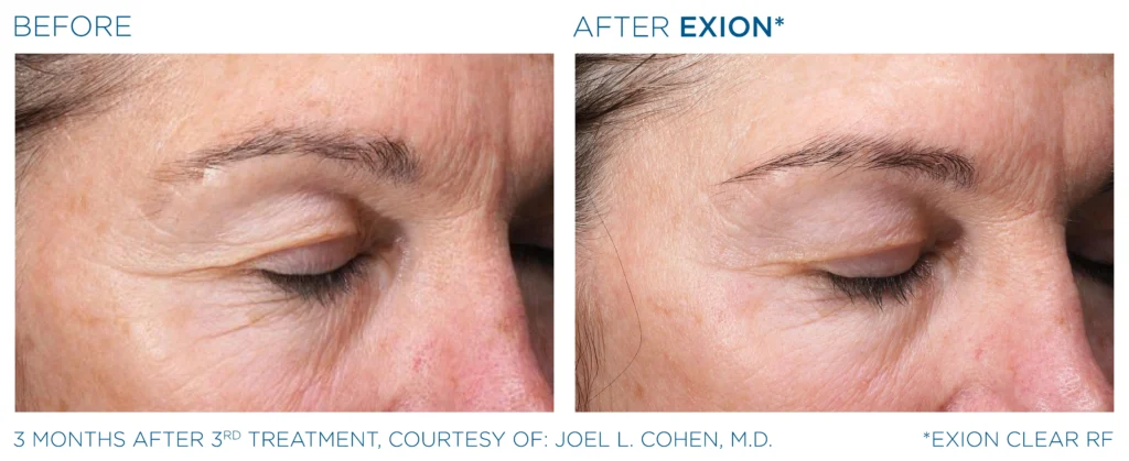 Exion PIC Ba card eyes female 109 Clear RF ENUS100 Exion