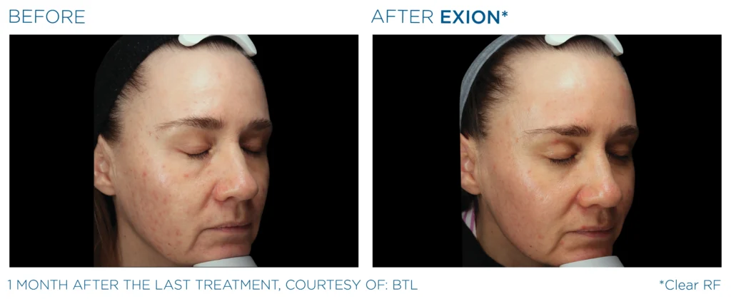 Exion PIC Ba card face female 093 ENUS100 Exion
