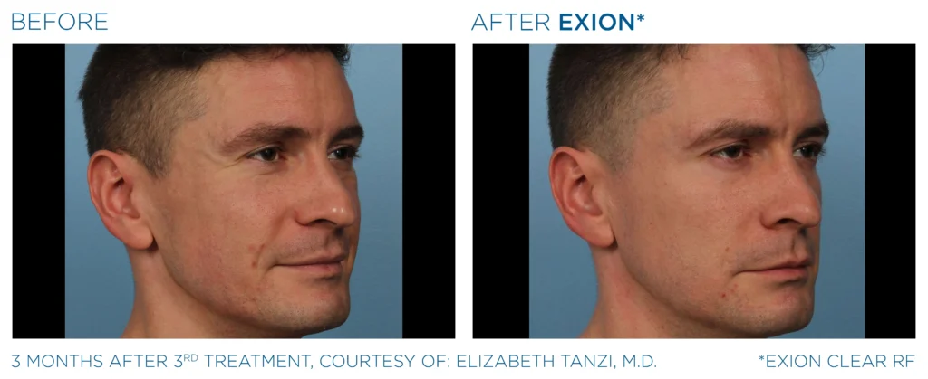 Exion PIC Ba card face male 112 Clear RF ENUS100 Exion