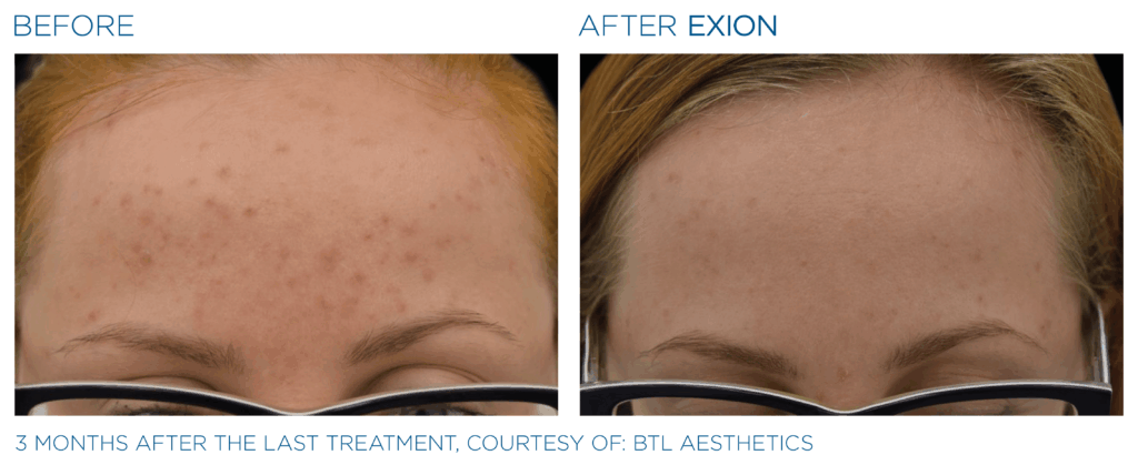 Exion PIC Ba card forehead female 064 FRF ENUS100 Exion
