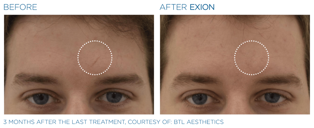 Exion PIC Ba card forehead male 022 FRF ENUS100 Exion