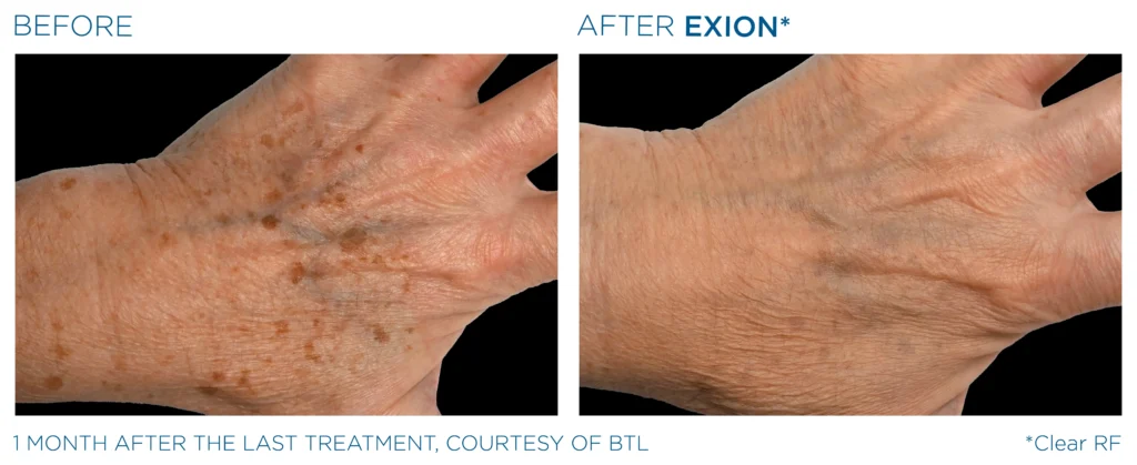 Exion PIC Ba card hand female 004 ClearRF ENUS100 Exion