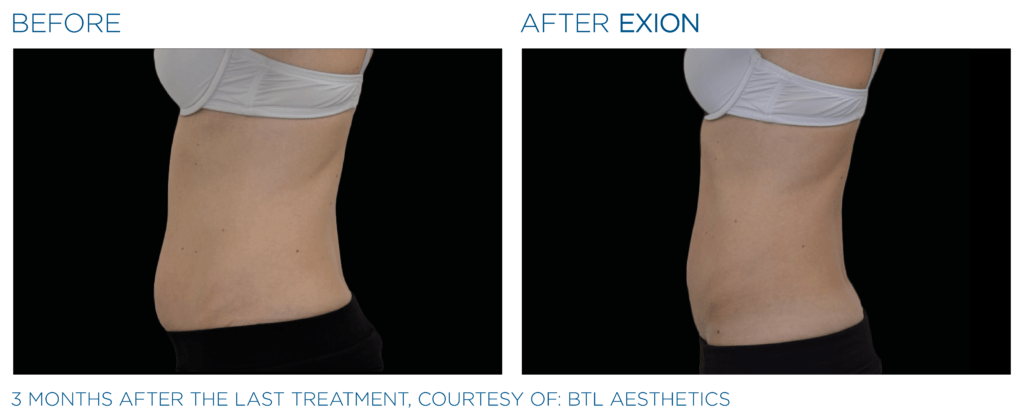 Exion PIC Ba card lateral abdomen female 034 Body ENUS100 Exion